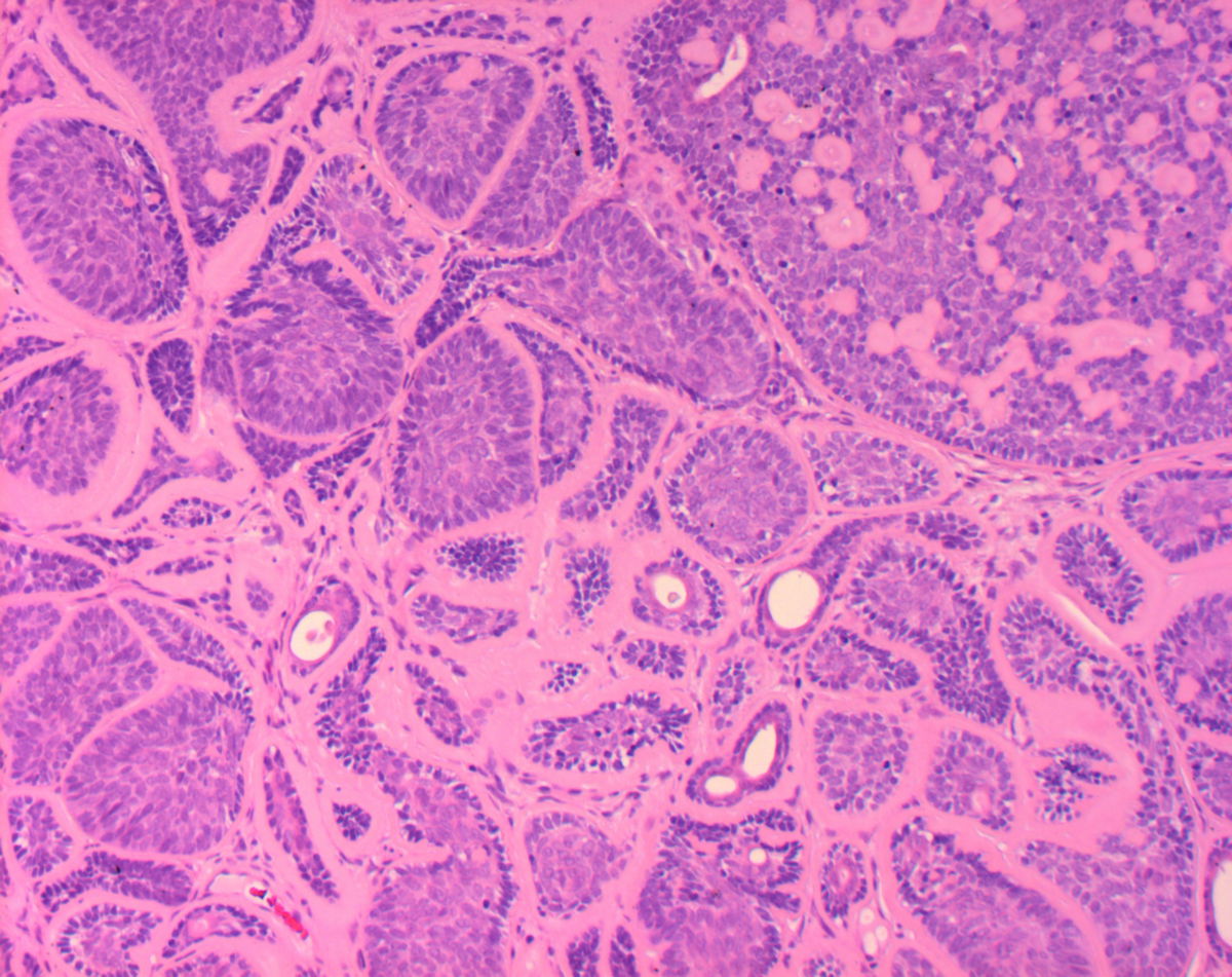Dermales Zylindrom (Histologie)