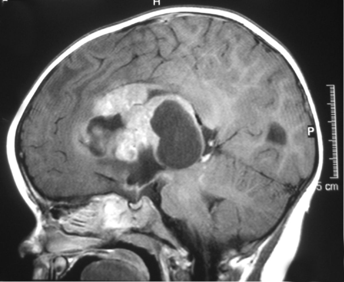 Atypischer teratoider/rhabdoider Tumor (MRT)
