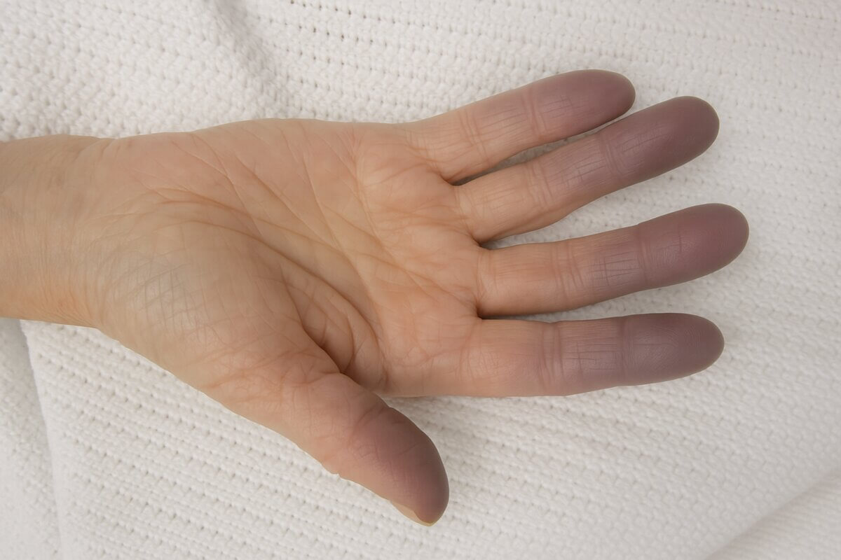 Zyanose der Finger