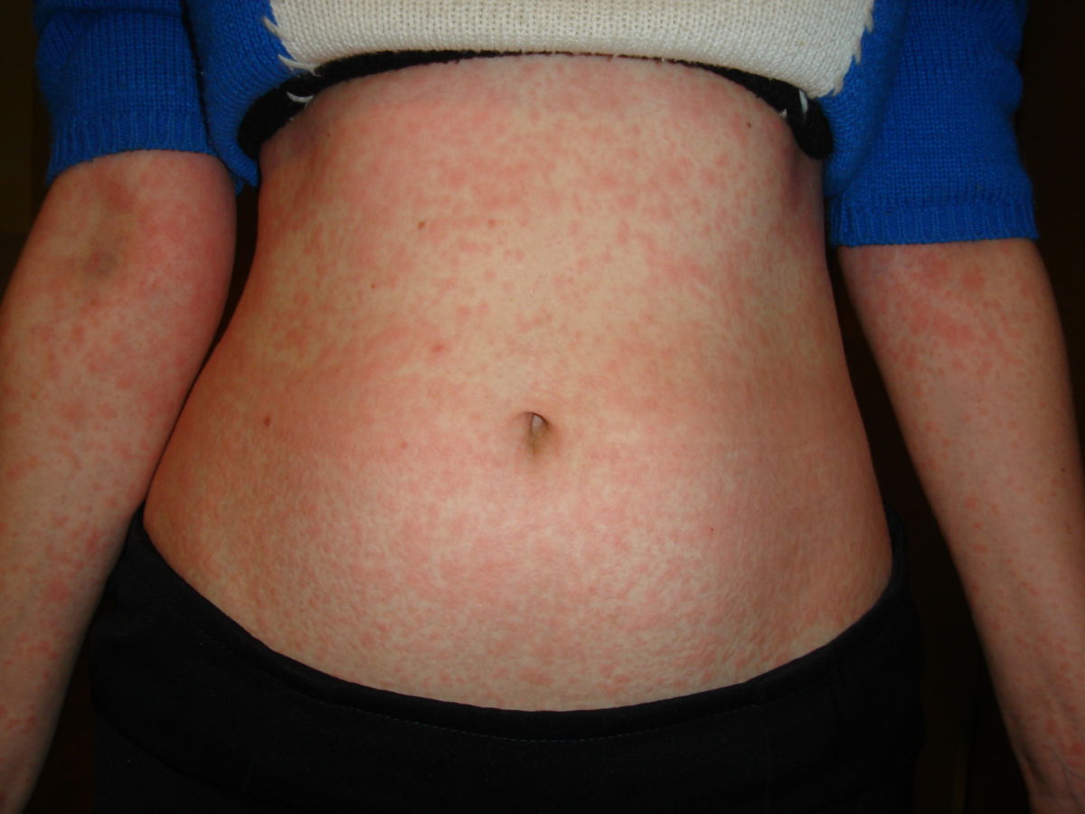 toxisches Exanthem bei Nevirapin