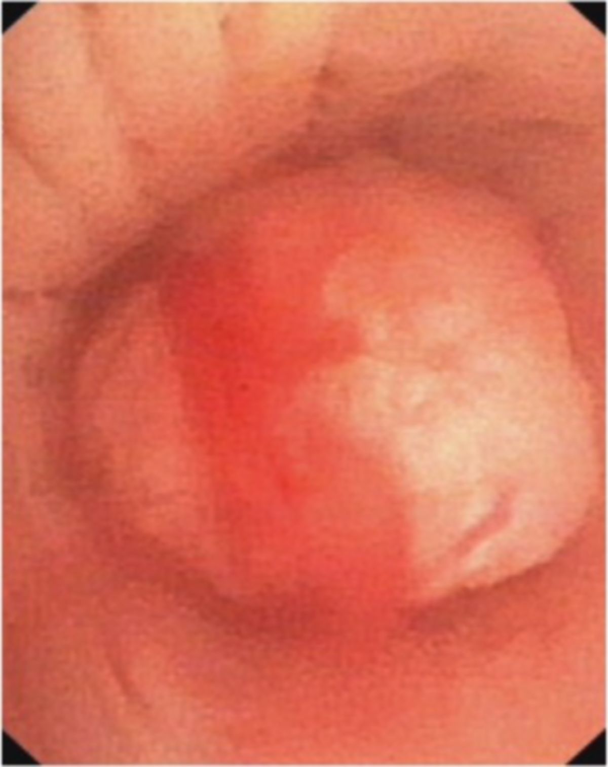 Bronchoskopie (NSCLC)