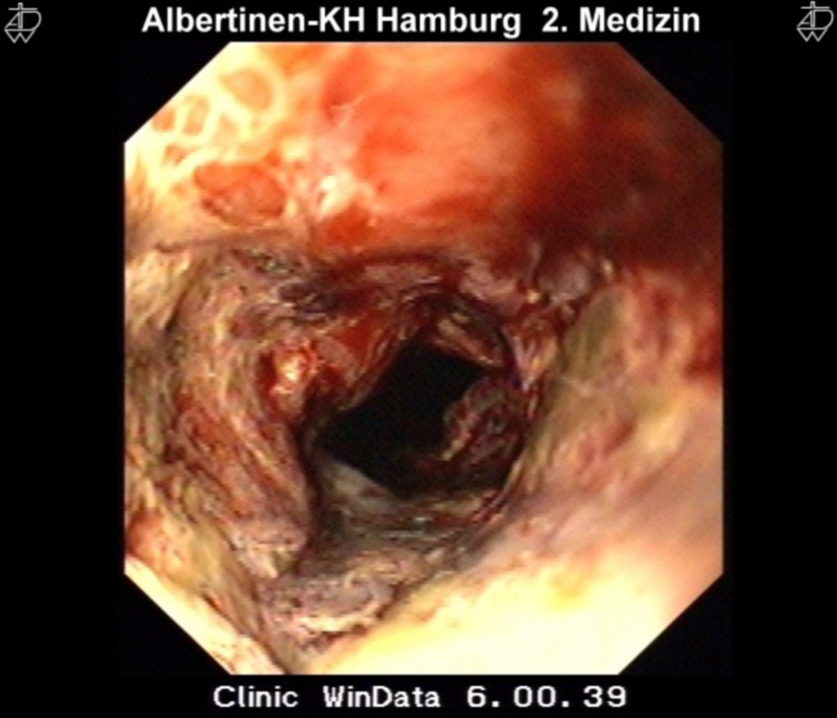 Oesophagus-Tumor