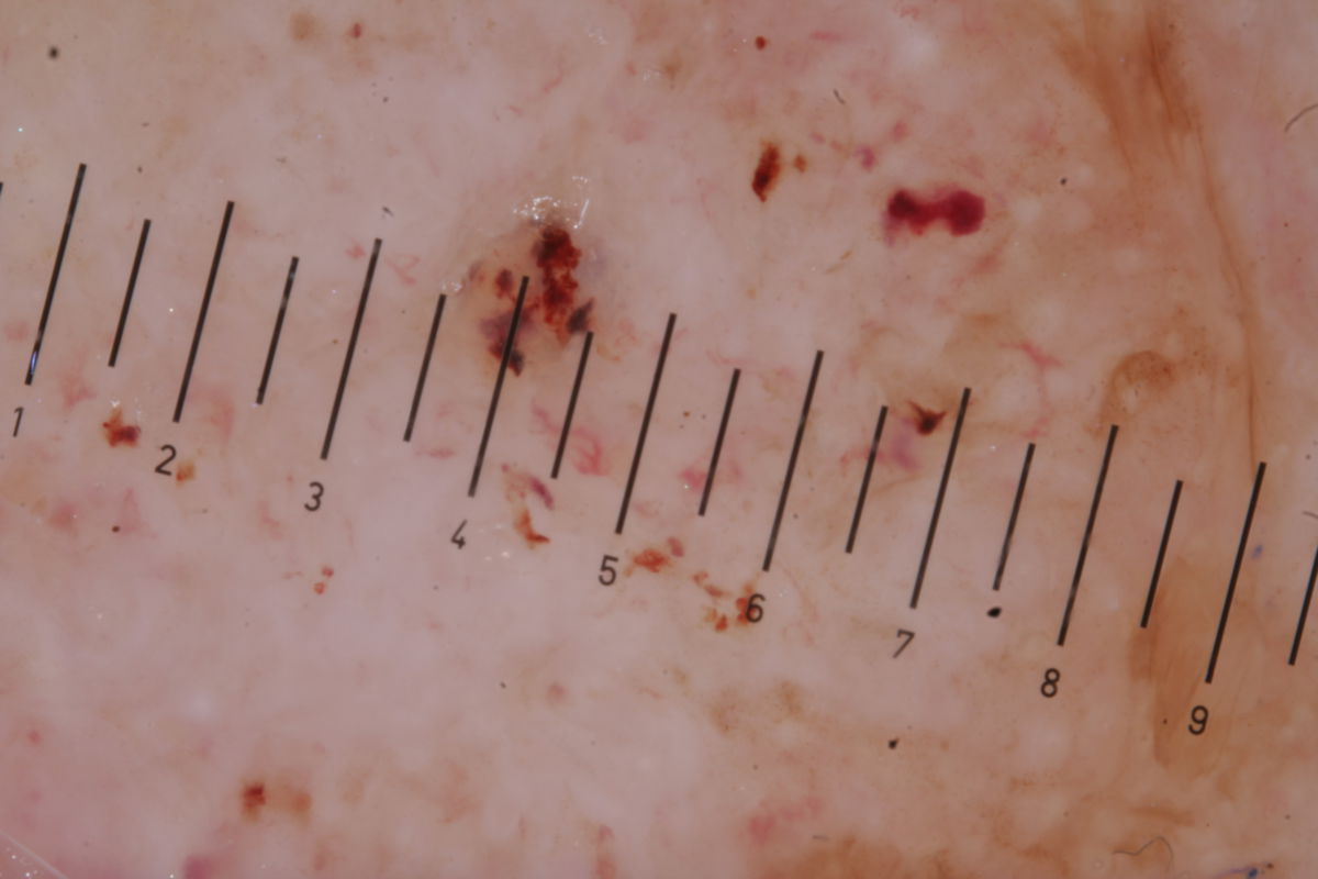 Basaliom dermatoskopisch