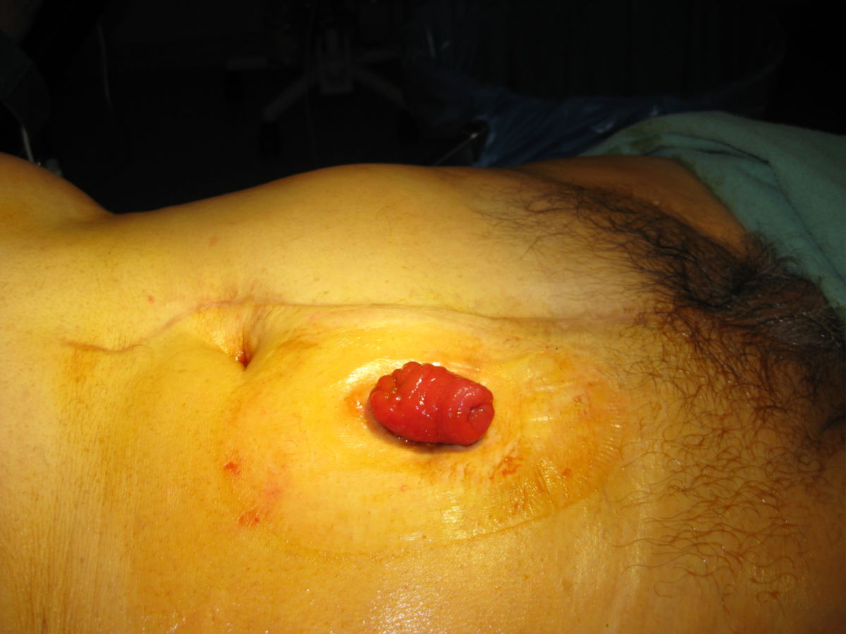 Ileostoma (protektiv)