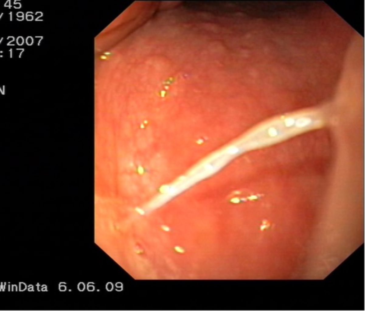 Fischgräte im Hypopharynx