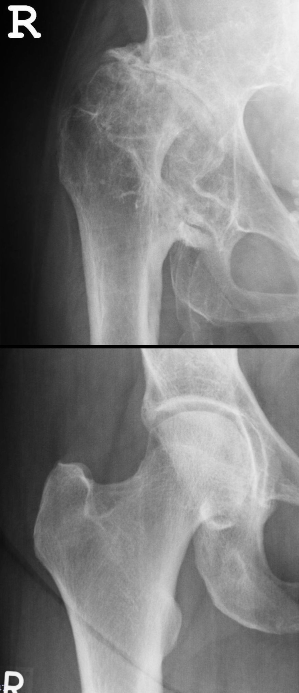 Dysplasie-Coxarthrose