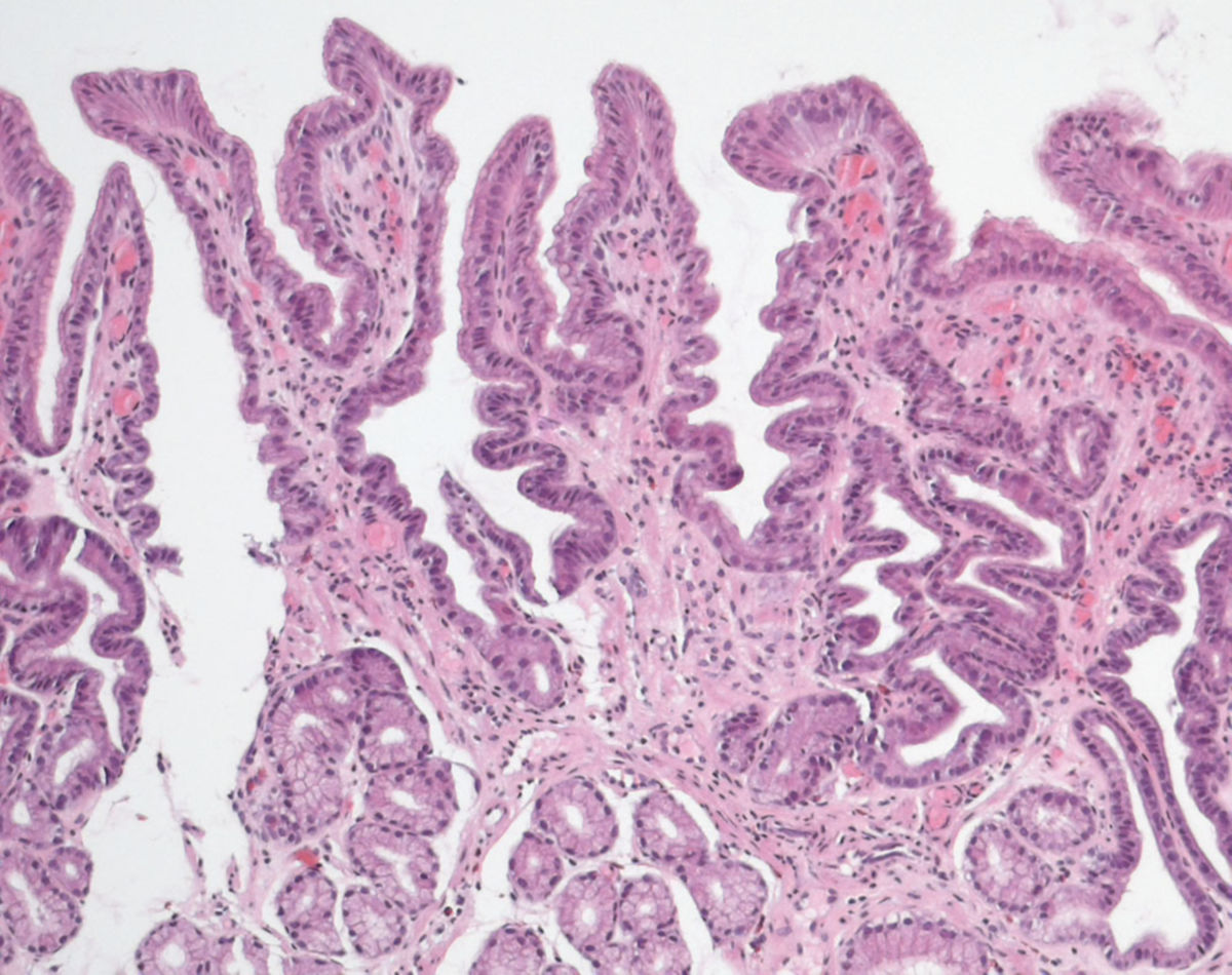 Chemisch reaktive Gastrophatie (Typ C Gastritis)