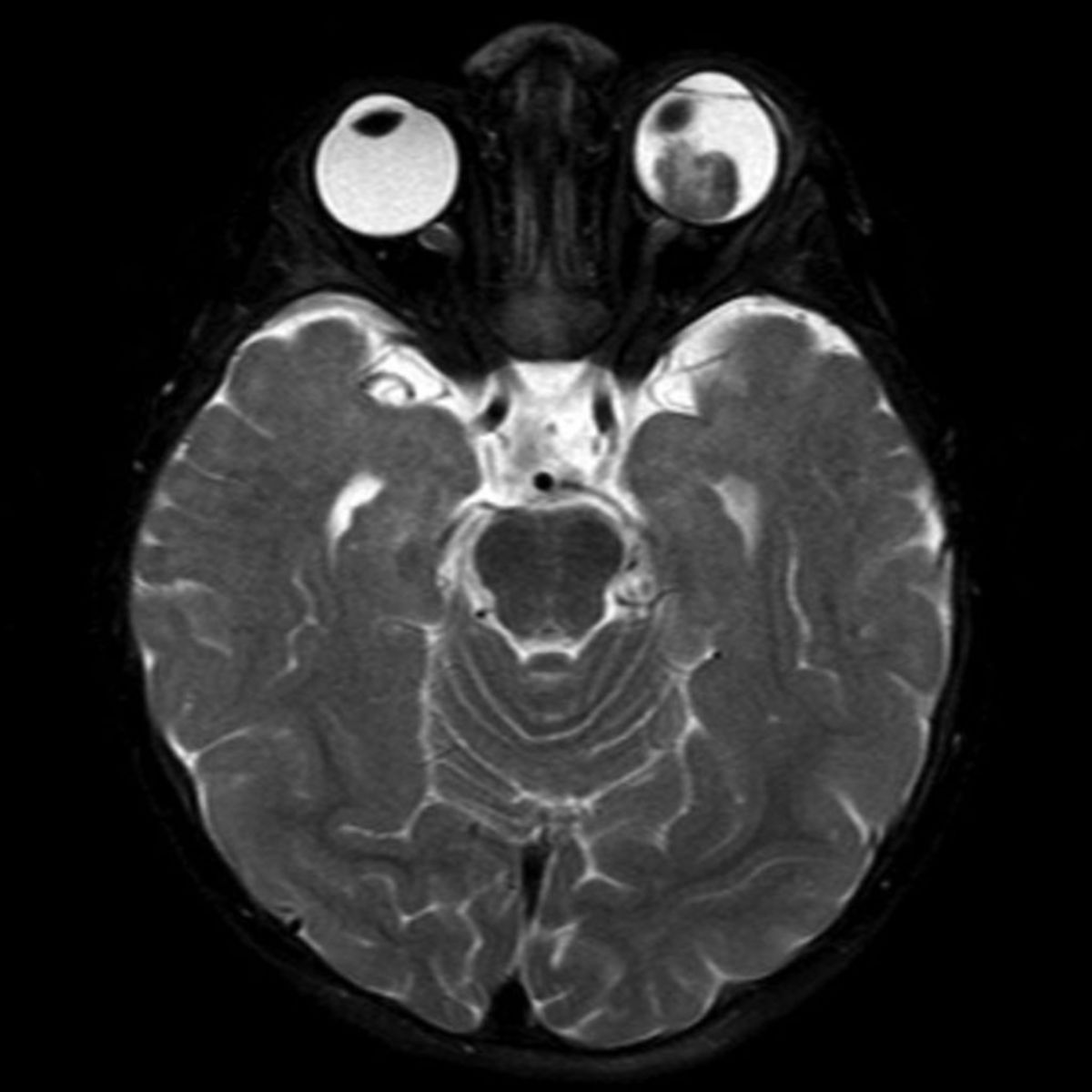 Retinoblastom (MRT/T2)