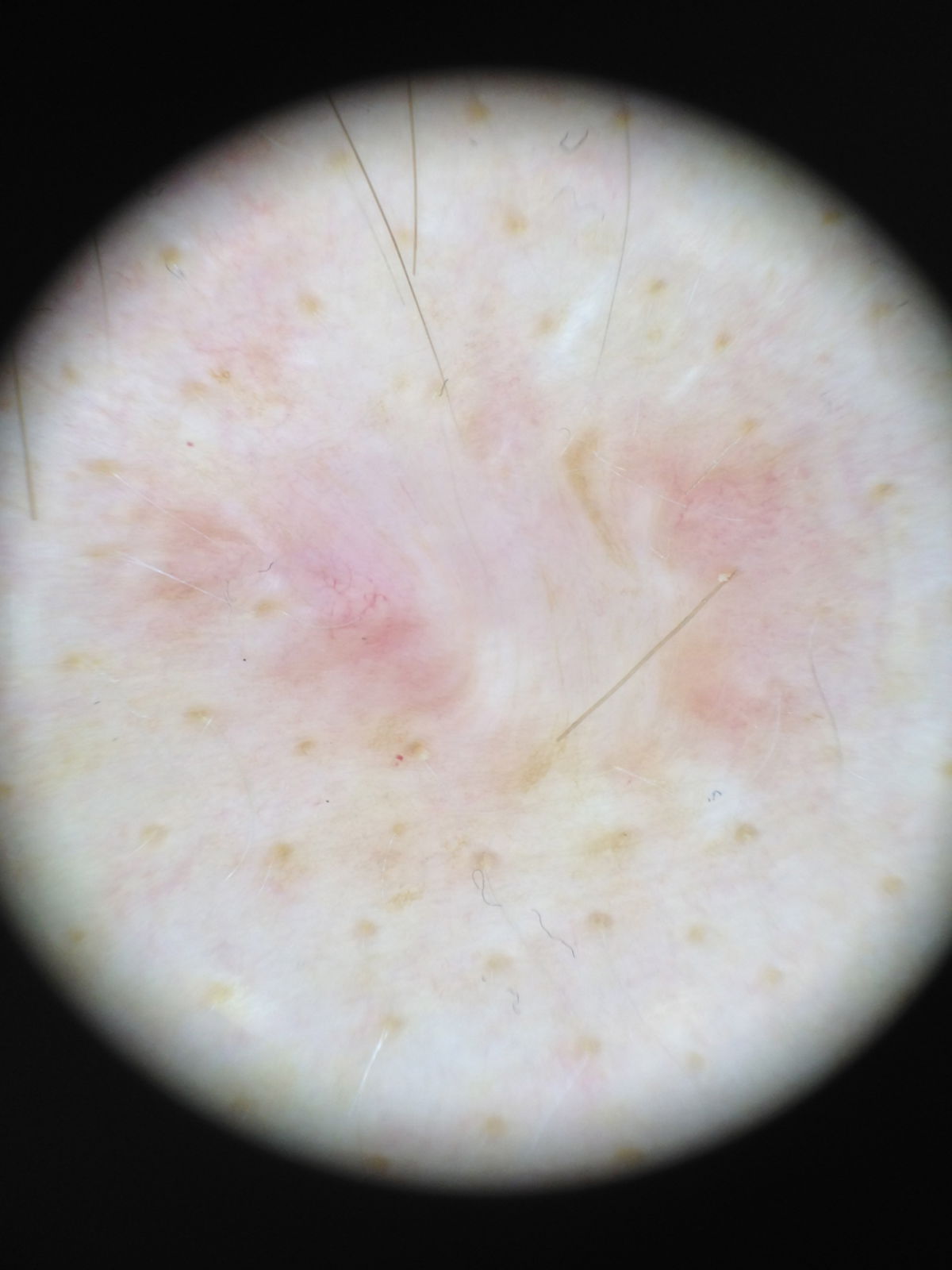 Narbenkeloid