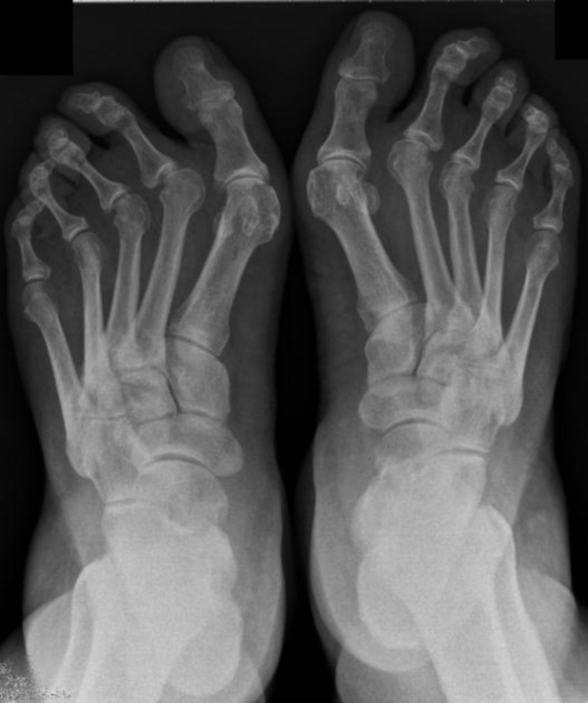 Spreizfuß und Hallux valgus bds.