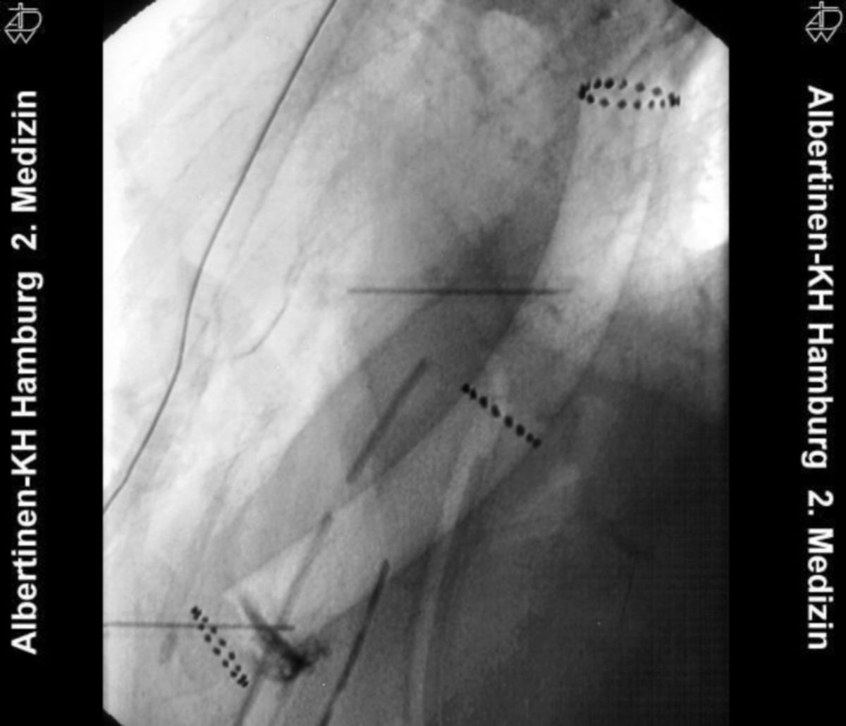 Oesophagus-Stent