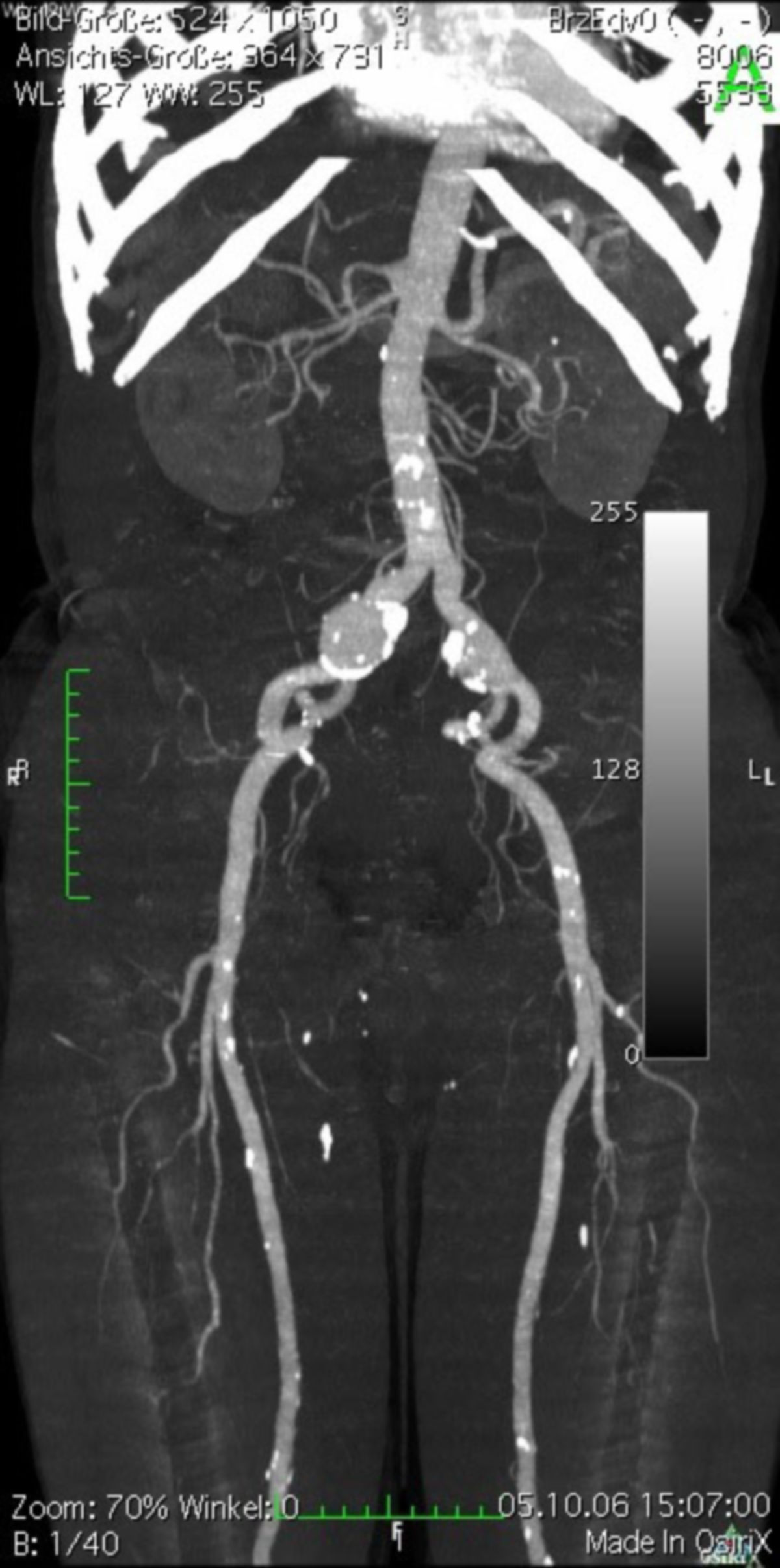 CT-Angiographie