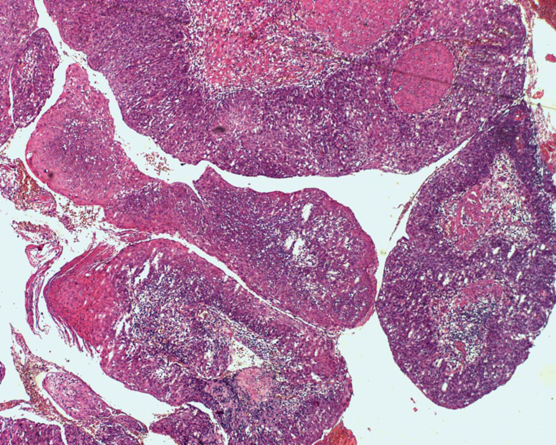 Analrandkarzinom - Histologie