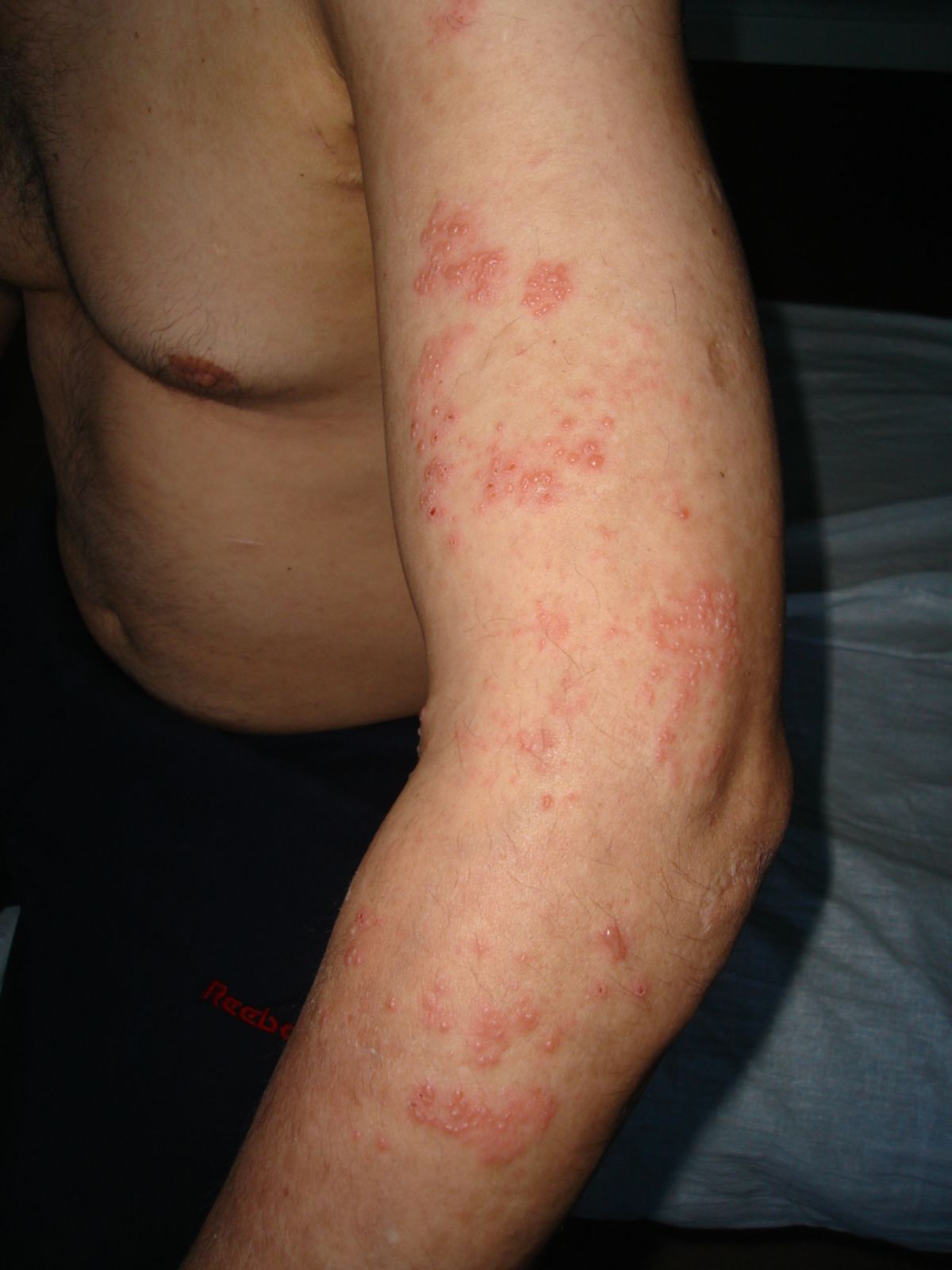Herpes Zoster