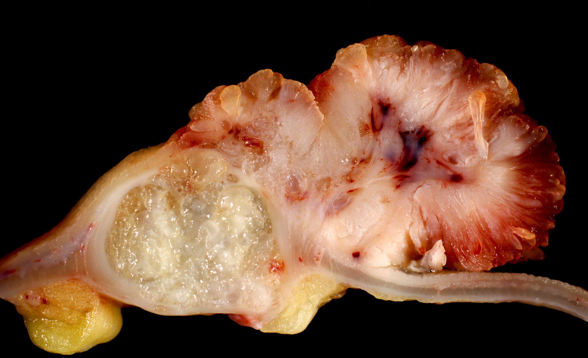 Adenomkarzinom und villöses Adenom des Colon ascendens