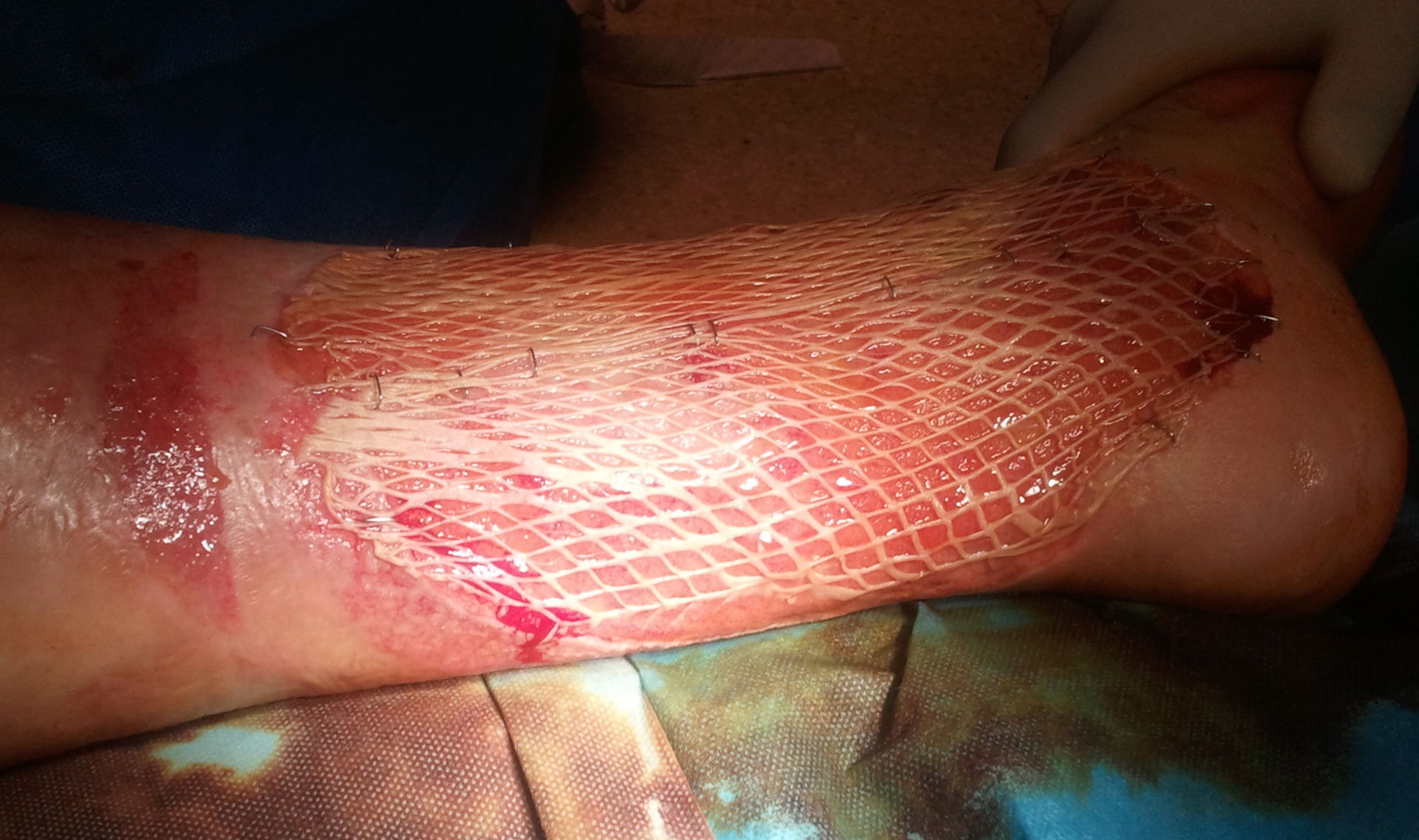 Ulkus cruris - Mesh graft transplantation