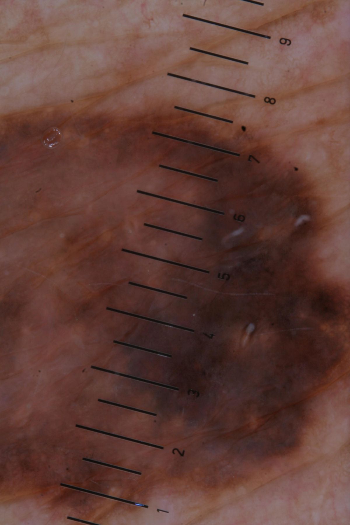 Melanom 1 dermatoskopisch