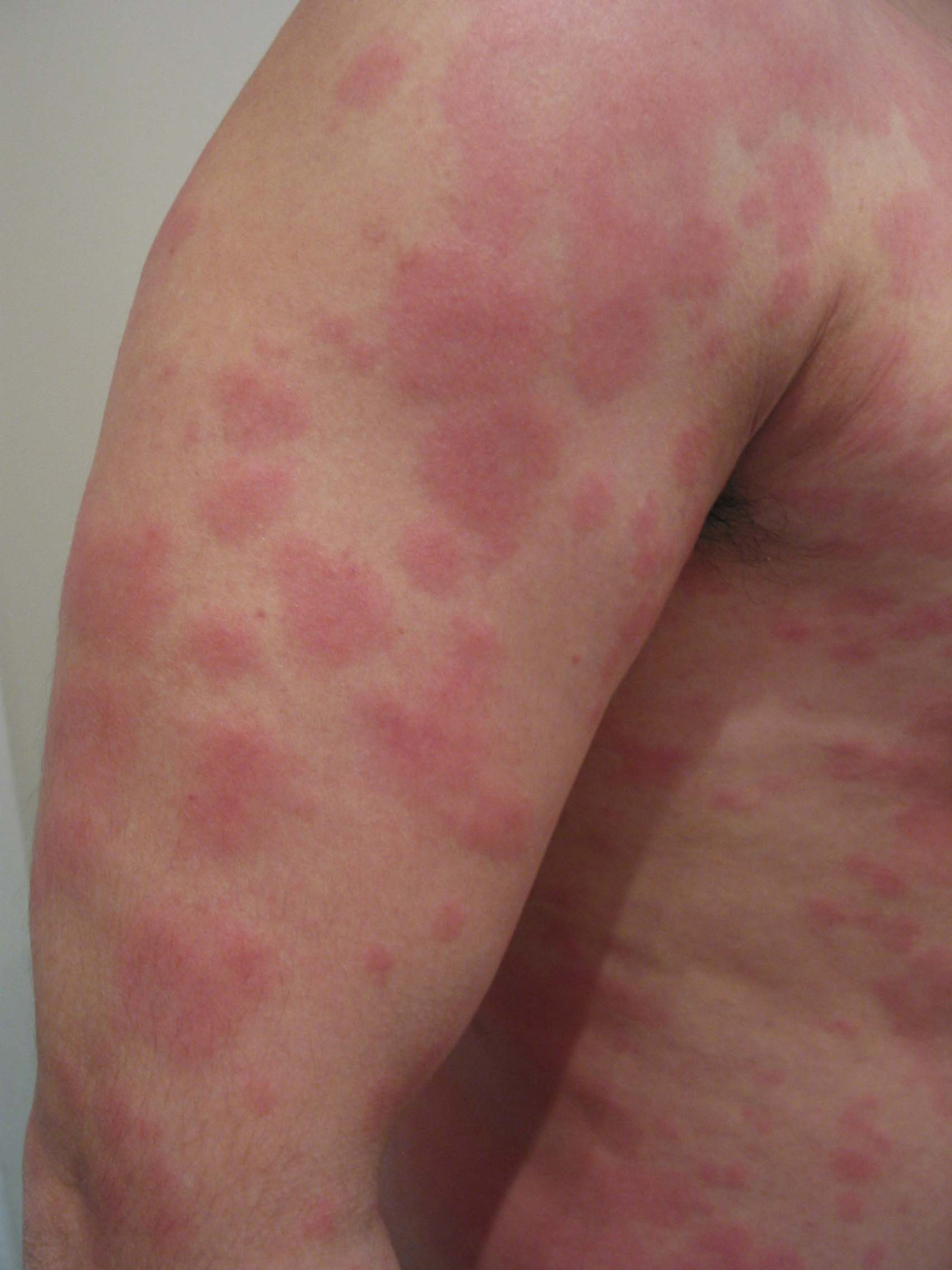 Akute Urticaria