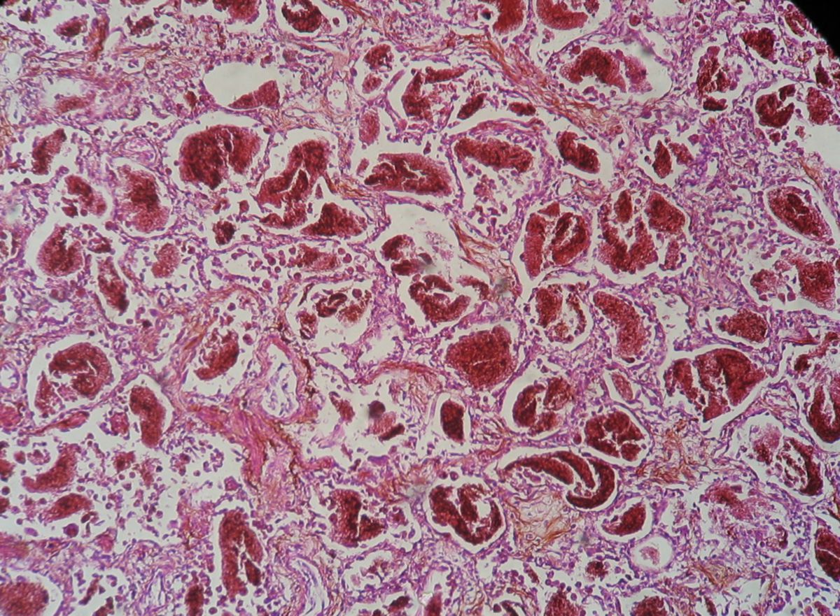 Pneumocystis-Pneumonie