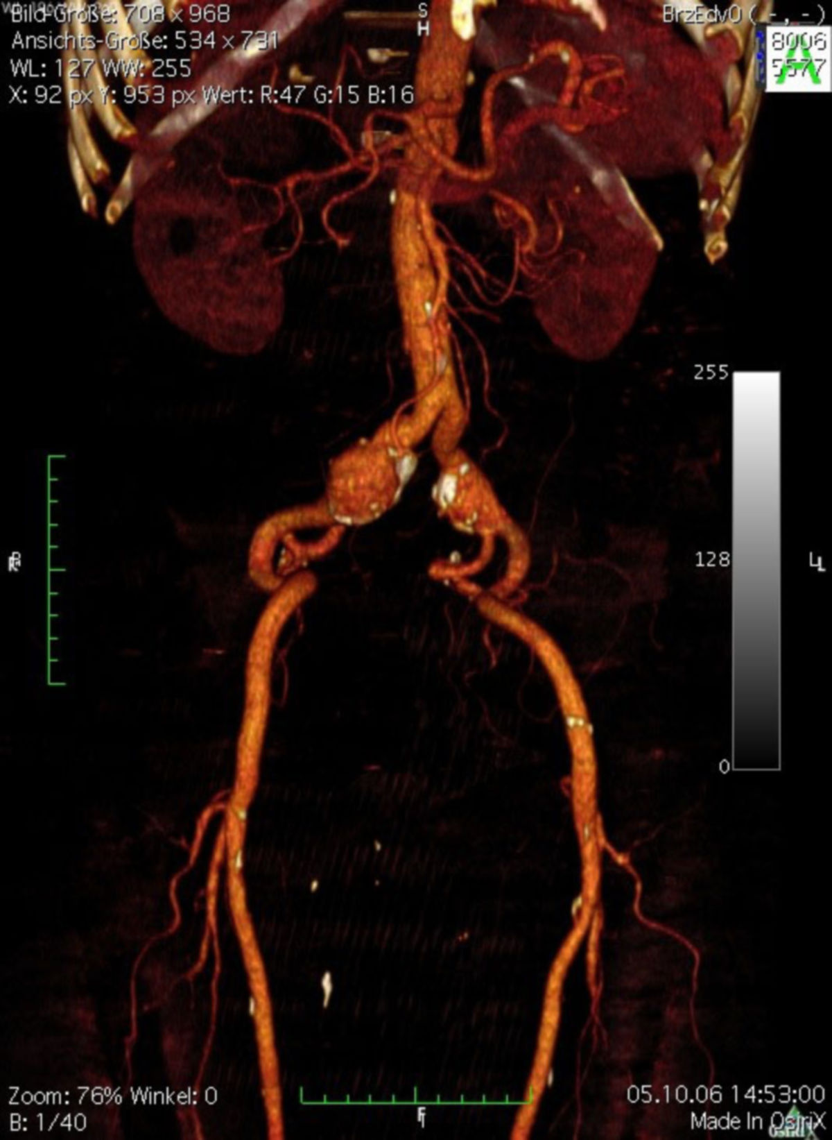 CT-Angiographie