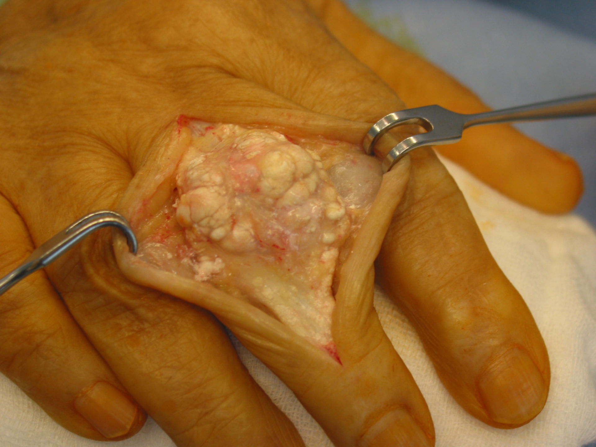 Gichttophus Mittelfinger