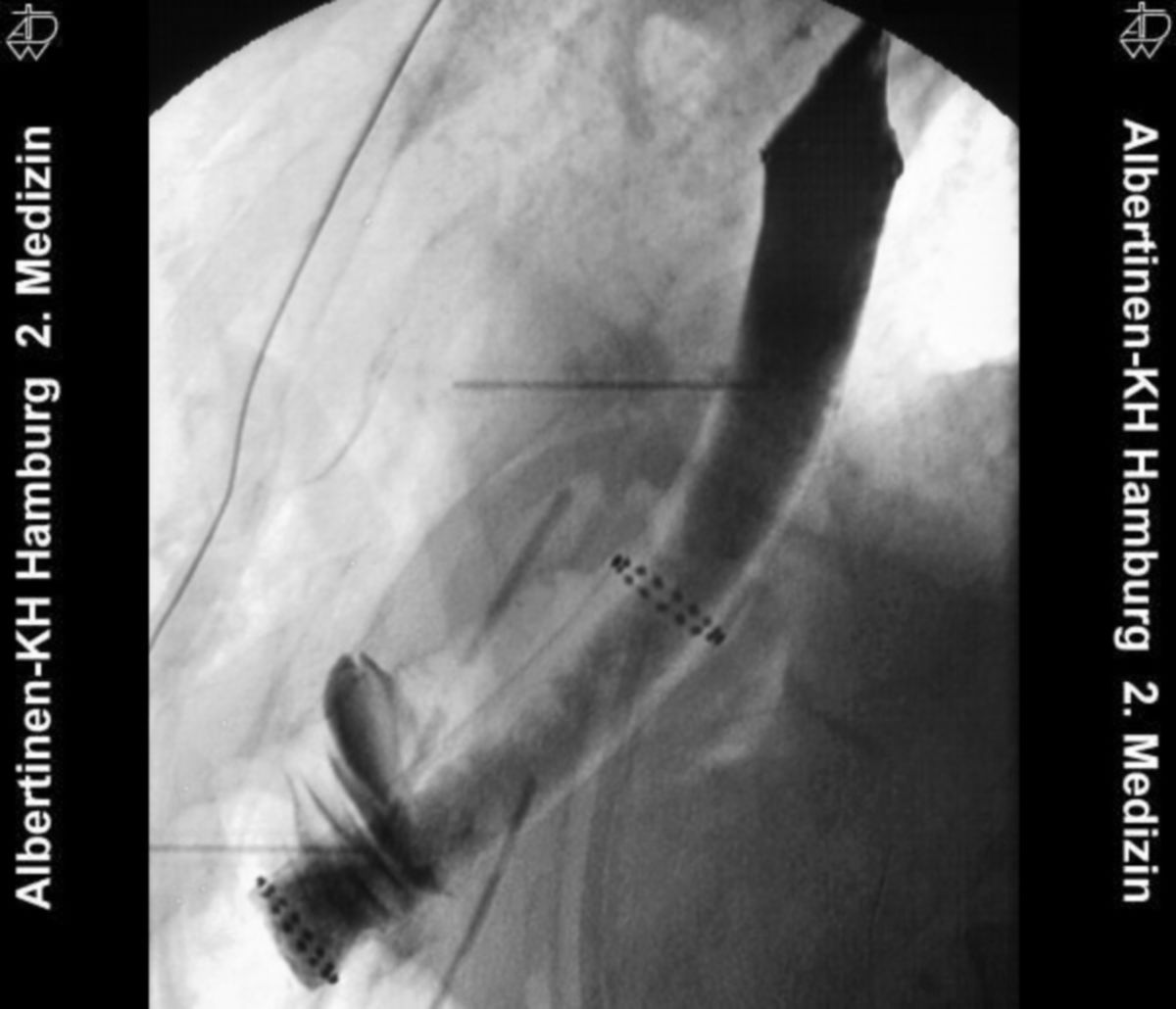 Oesophagus-Stent
