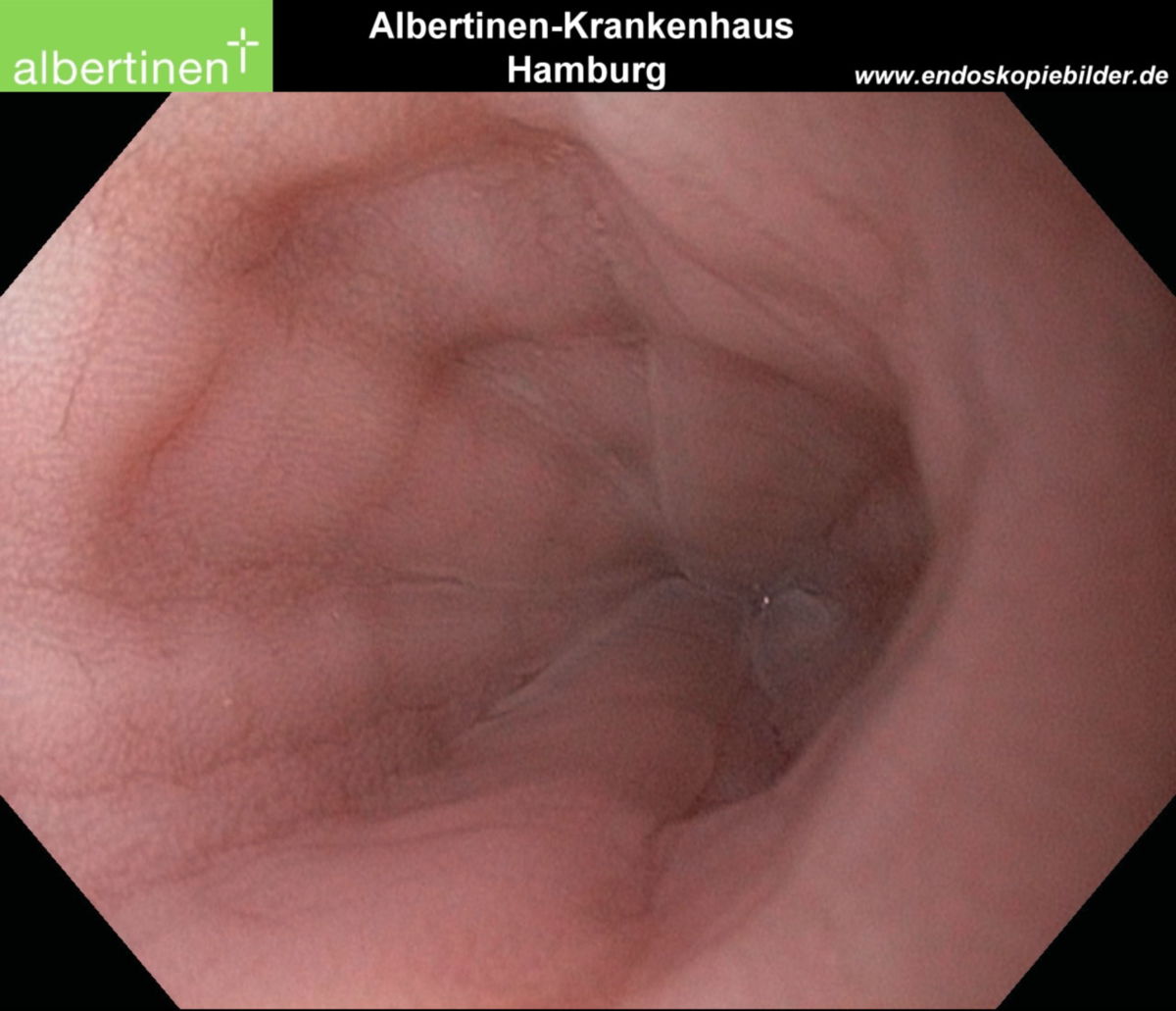 Tubulärer Ösophagus normal Endo